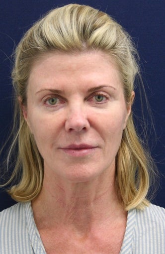 Short Incision face lift and neck lift before 223309