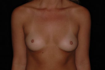 Breast Augmentation before 336247