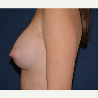 25-34 year old woman treated with Breast Augmentation after 3455336
