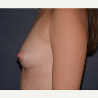 25-34 year old woman treated with Breast Augmentation before 3455336