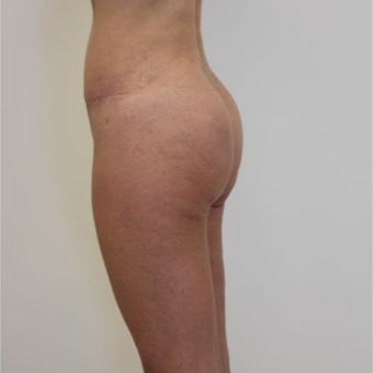 35-44 year old woman treated with Butt Implants after 1768719