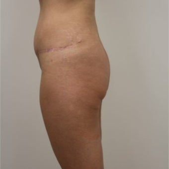 35-44 year old woman treated with Butt Implants before 1768719