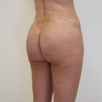35-44 year old woman treated with Butt Implants 1768719