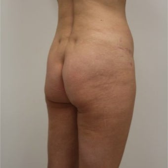 35-44 year old woman treated with Butt Implants 1768719