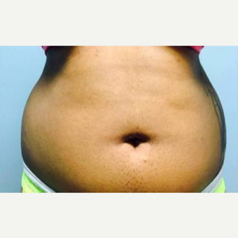 18-24 year old woman treated with Laser Liposuction before 3764370