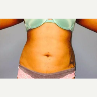 18-24 year old woman treated with Laser Liposuction after 3764370