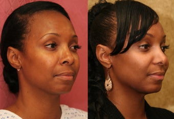 African American Rhinoplasty before 967902