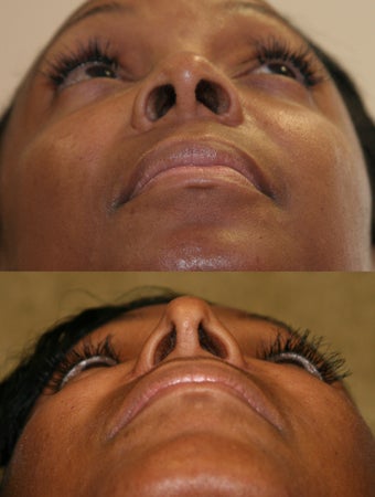 African American Rhinoplasty 967902
