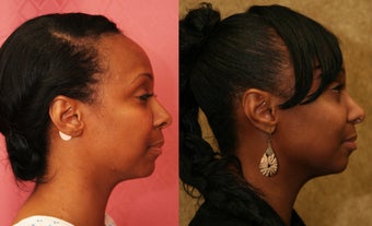African American Rhinoplasty after 967902