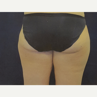 35-44 year old woman treated with Liposuction before 3375869