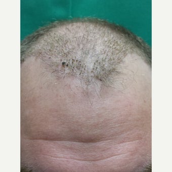 Our NeoGraft Patient's Journey —Day #14 Post Procedure after 1717031
