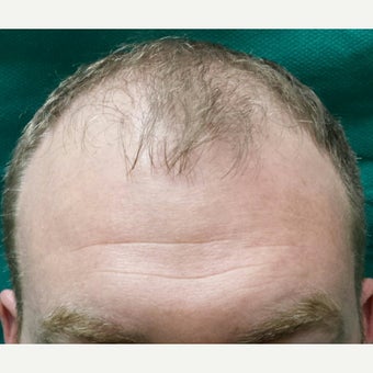 Our NeoGraft Patient's Journey —Day #14 Post Procedure before 1717031