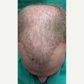Our NeoGraft Patient's Journey —Day #14 Post Procedure 1717031