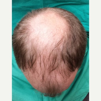 Our NeoGraft Patient's Journey —Day #14 Post Procedure 1717031