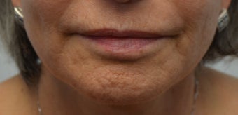 60 year old female treated with SkinPen series before 1129990
