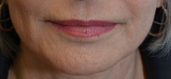 60 year old female treated with SkinPen series after 1129990