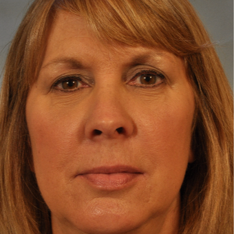 55-64 year old woman treated with Eyelid Surgery after 3337459
