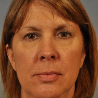 55-64 year old woman treated with Eyelid Surgery before 3337459