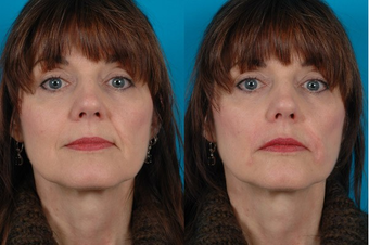 52-year-old woman treated with Restylane™. before 574583