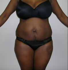Tummy Tuck before 1474853