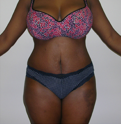 Tummy Tuck after 1474853