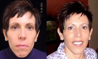Juvederm Voluma before 1199526