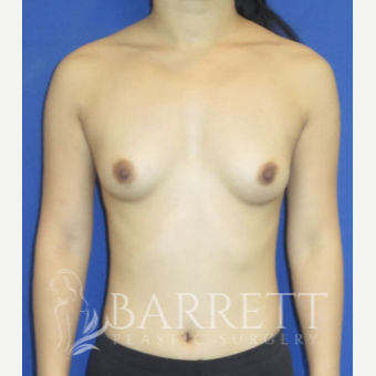25-34 year old woman treated with Breast Augmentation before 3611928