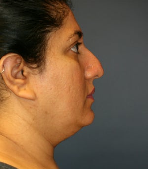 Rhinoplasty and Thermi-Tight (Thermi-RF) to neck 1304663