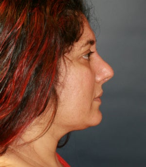Rhinoplasty and Thermi-Tight (Thermi-RF) to neck 1304663