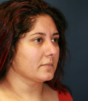 Rhinoplasty and Thermi-Tight (Thermi-RF) to neck after 1304663
