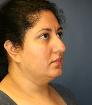 Rhinoplasty and Thermi-Tight (Thermi-RF) to neck before 1304663