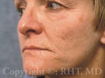 Laser Resurfacing (ablative CO2/Erbium:YAG) and permanent lip enlargement before 259363