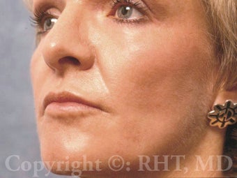 Laser Resurfacing (ablative CO2/Erbium:YAG) and permanent lip enlargement after 259363