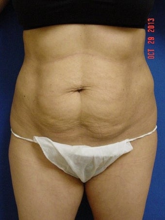 25-34 year old woman treated for Tummy Tuck before 1534953