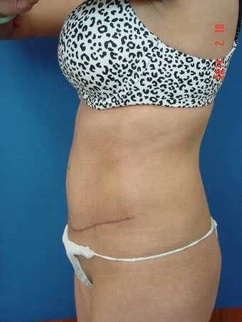 25-34 year old woman treated for Tummy Tuck 1534953