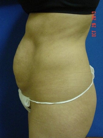 25-34 year old woman treated for Tummy Tuck 1534953