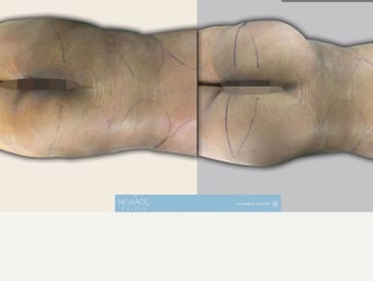 25-34 year old woman treated with Butt Augmentation before 3708809