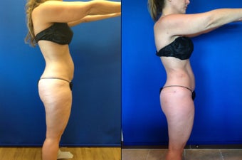 46 year old female for improvement of body contour 1416209