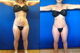 46 year old female for improvement of body contour after 1416209