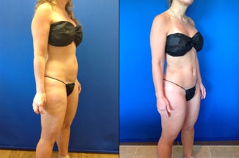 46 year old female for improvement of body contour 1416209