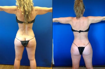 46 year old female for improvement of body contour before 1416209