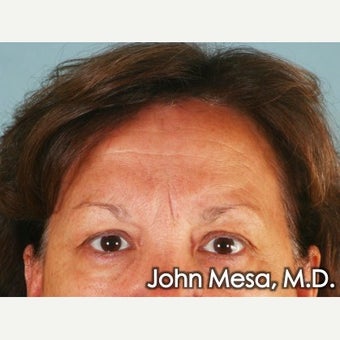 Forehead Lift (endoscopic) before 1682000