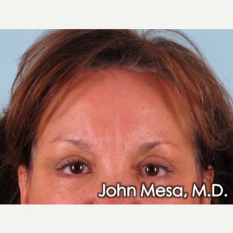 Forehead Lift (endoscopic) after 1682000