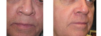 Mole Removal photos before 951893