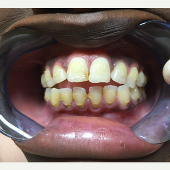 25-34 year old woman treated with Porcelain Veneers before 2686279