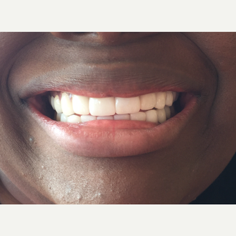 25-34 year old woman treated with Porcelain Veneers after 2686279