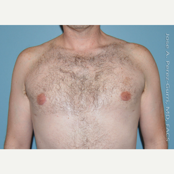 35-44 year old man treated with Male Breast Reduction after 3060167