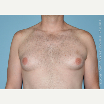 35-44 year old man treated with Male Breast Reduction before 3060167