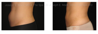 35-44 year old woman treated with CoolSculpting before 3690453