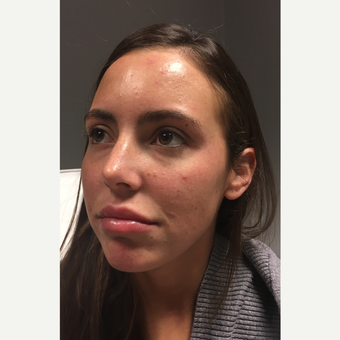 25-34 year old woman treated with Restylane before 3804085